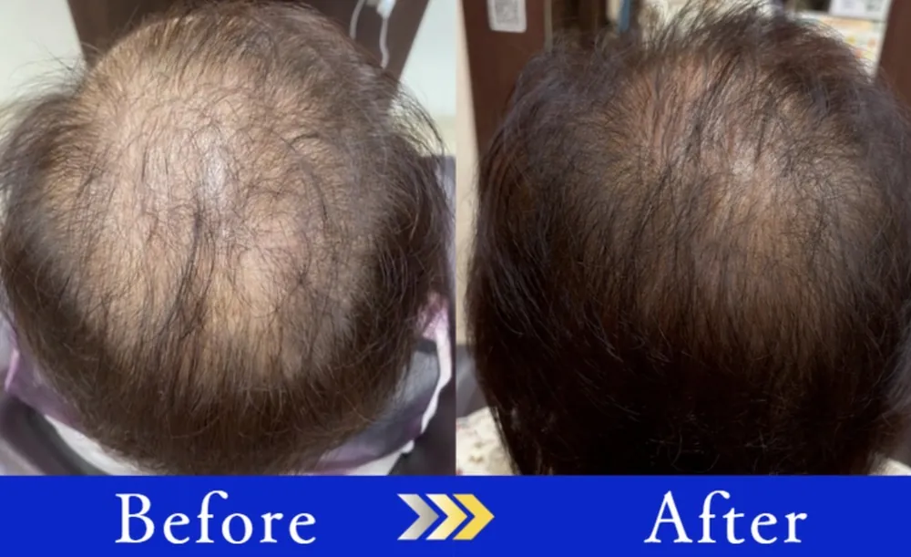 Before After ひさこさん
